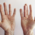 Dupuytrens kontraktur (vikingasjukan): symtom, orsaker & behandling